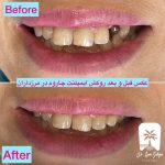 بهترین برند ایمپلنت در دنیا