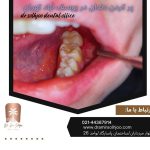 پر کردن دندان در یوسف آباد تهران
