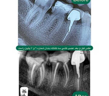 قیمت عصب کشی سه کاناله