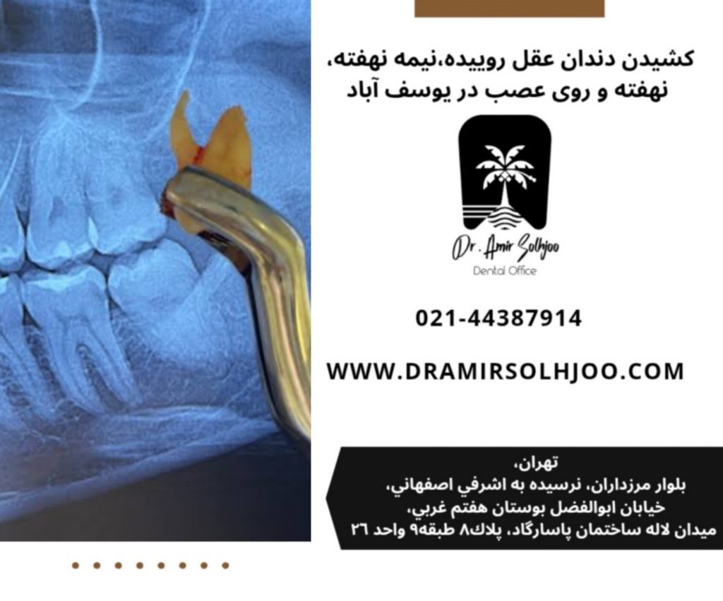 کشیدن دندان عقل روییده، نیمه نهفته، نهفته و روی عصب در یوسف آباد تهران