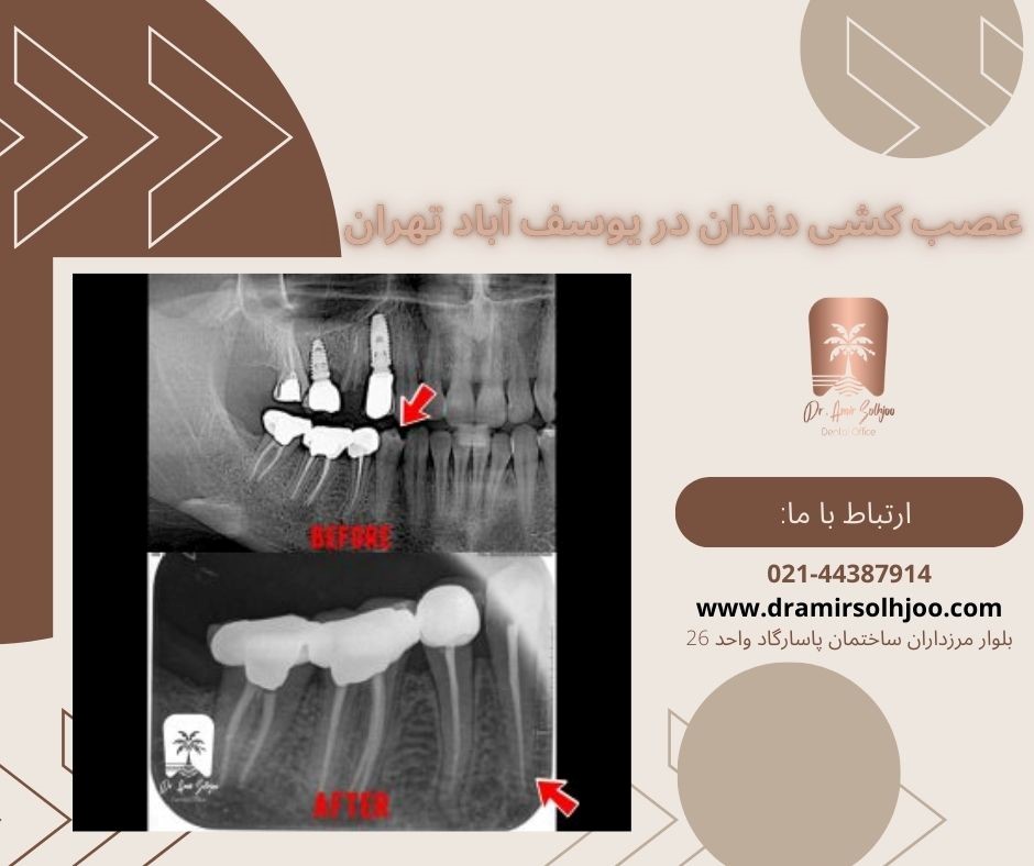 عصب کشی دندان در یوسف آباد تهران
