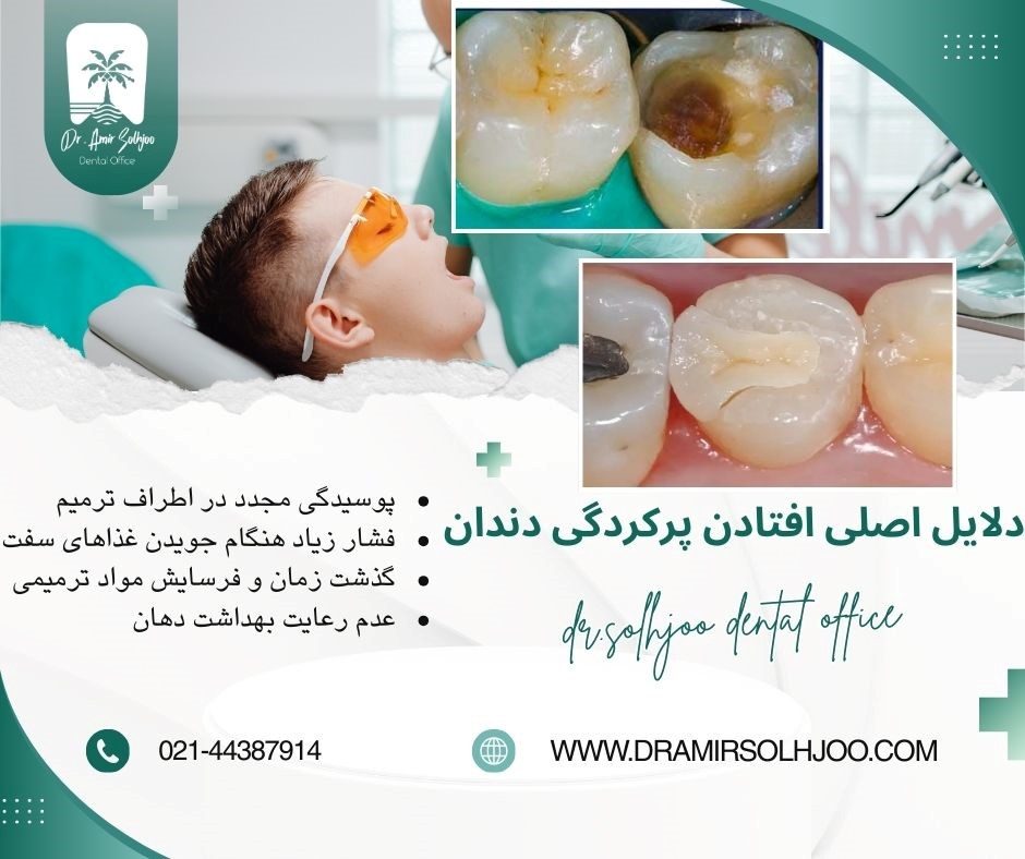 افتادن پرکردگی دندان