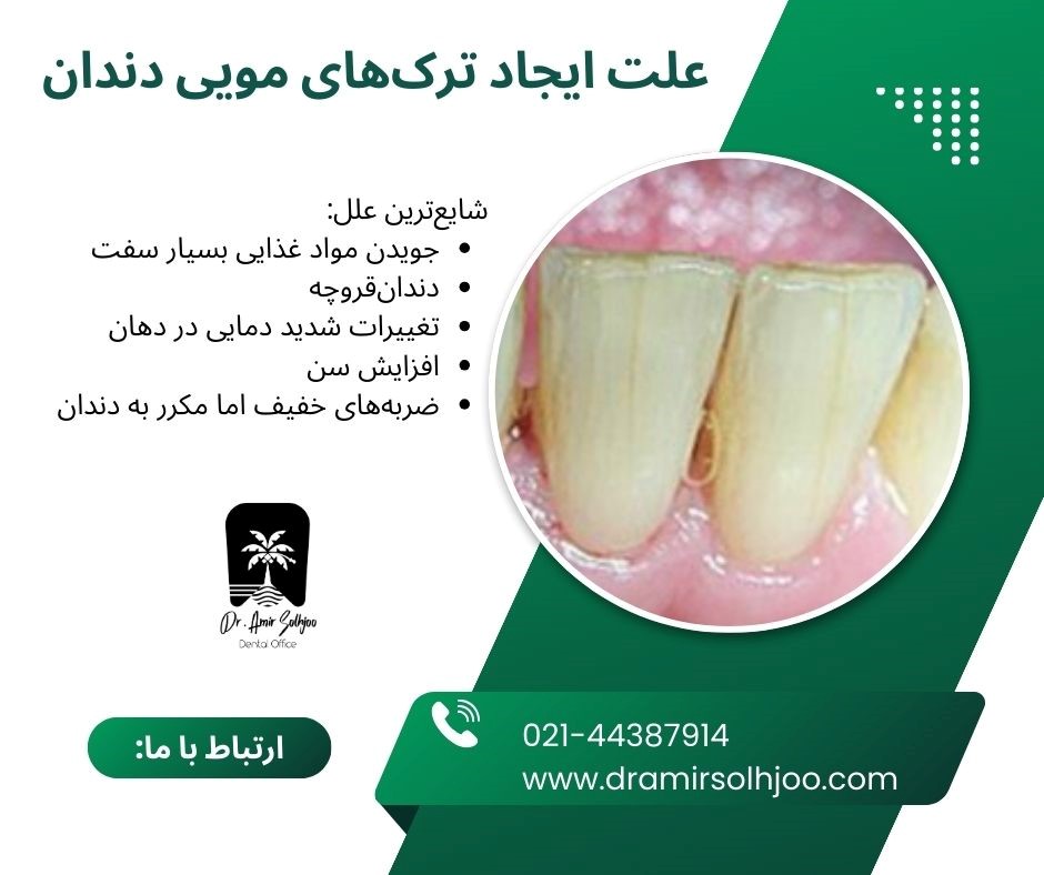 ترکهای مویی دندان