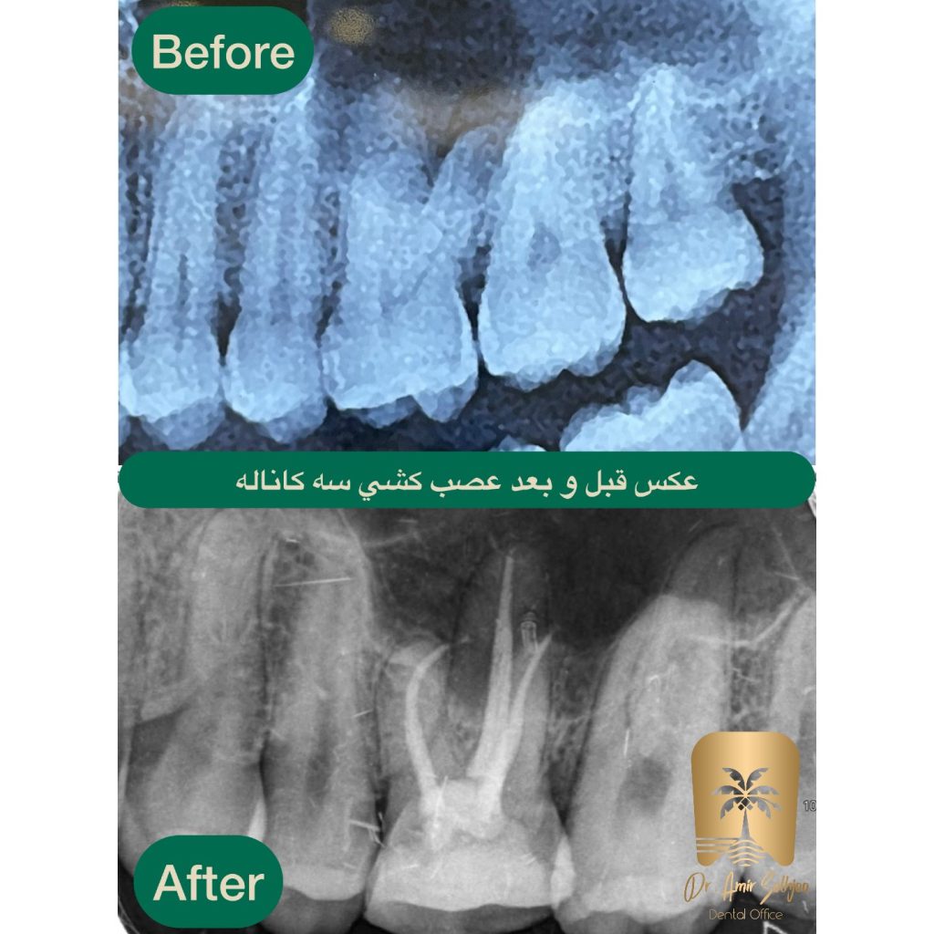 قیمت عصب کشی سه کاناله