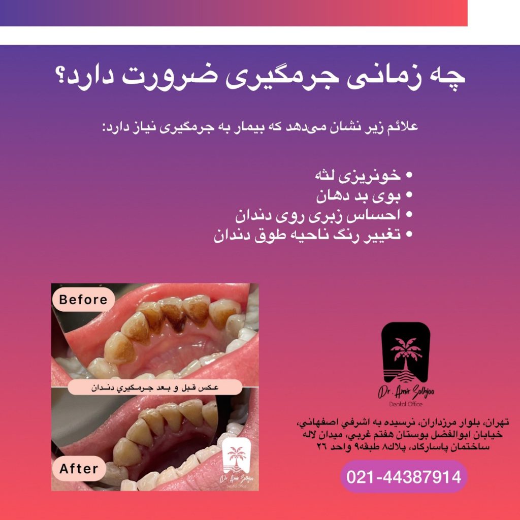 تفاوت جرمگیری و بروساژ