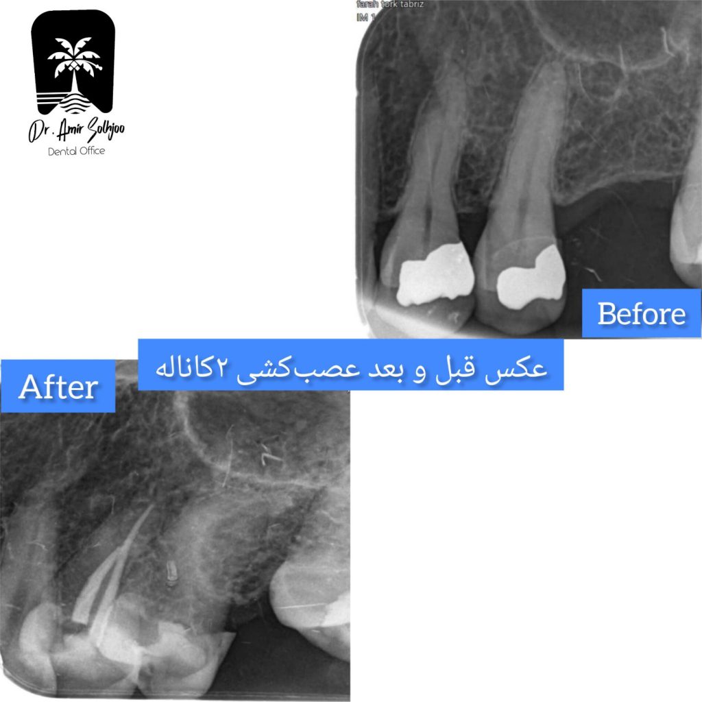 قیمت عصب کشی دوکاناله
