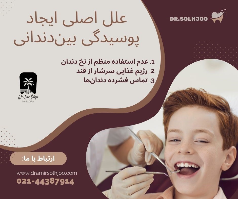 پوسیدگی بین دندانی