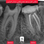 عصبکشی دندان در یوسف آباد تهران