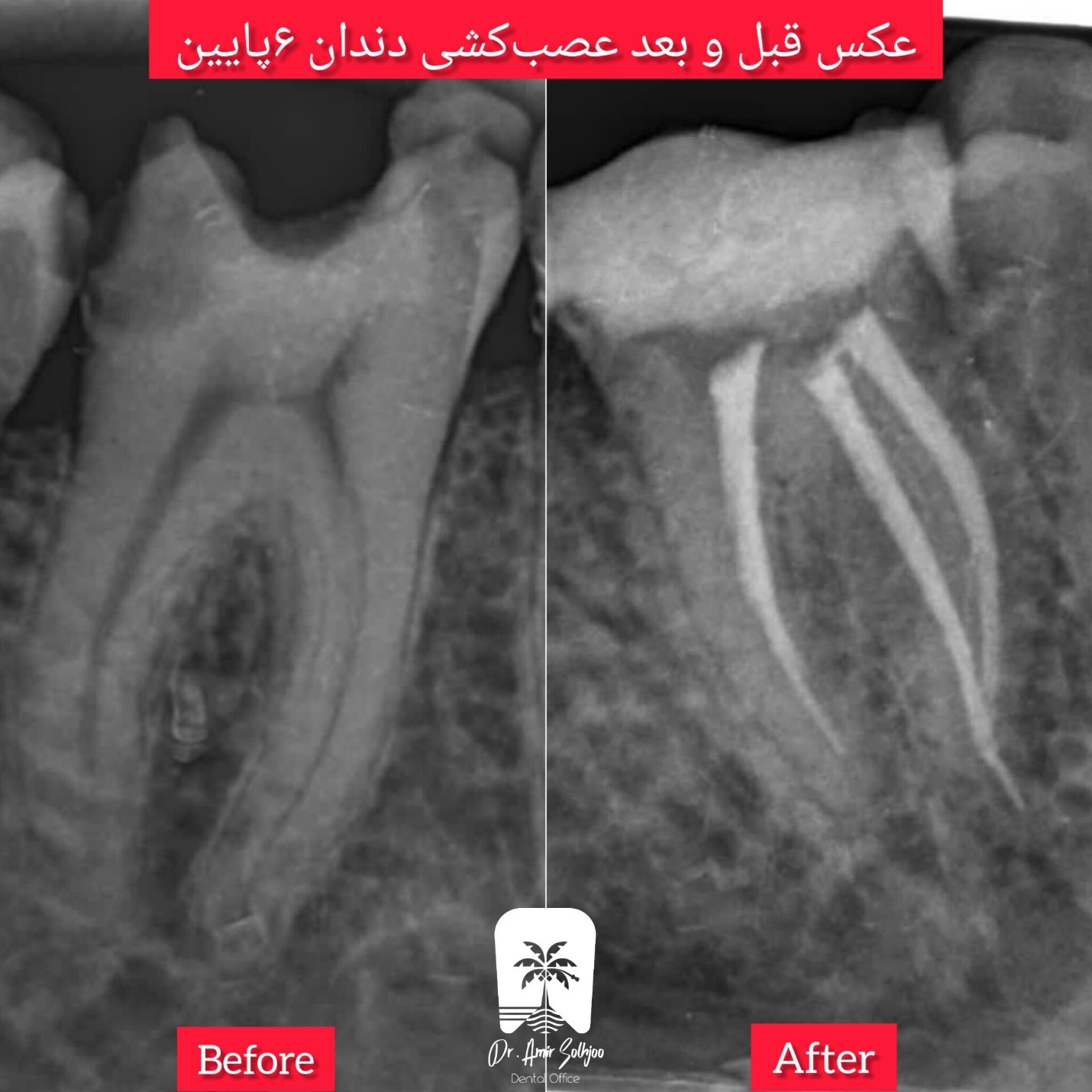 عصبکشی دندان در یوسف آباد تهران