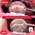 پرکردن دندان در سهروردی تهران