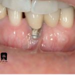 تحلیل استخوان اطراف ایمپلنت