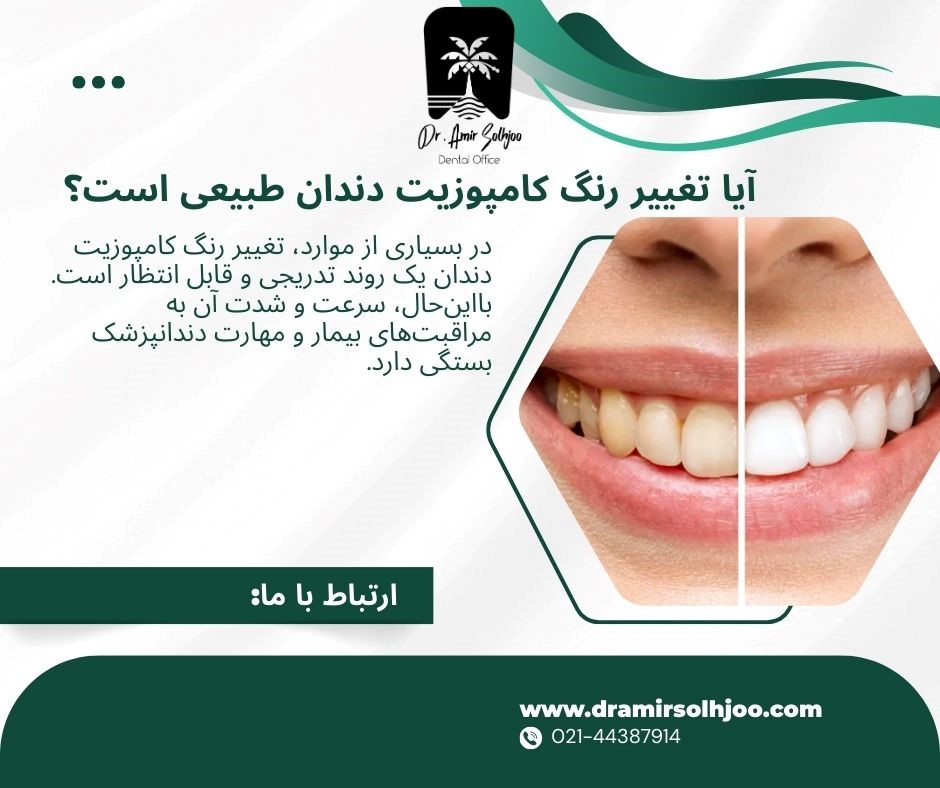 تغییر رنگ کامپوزیت دندان