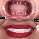 ایمپلنت تمام فک