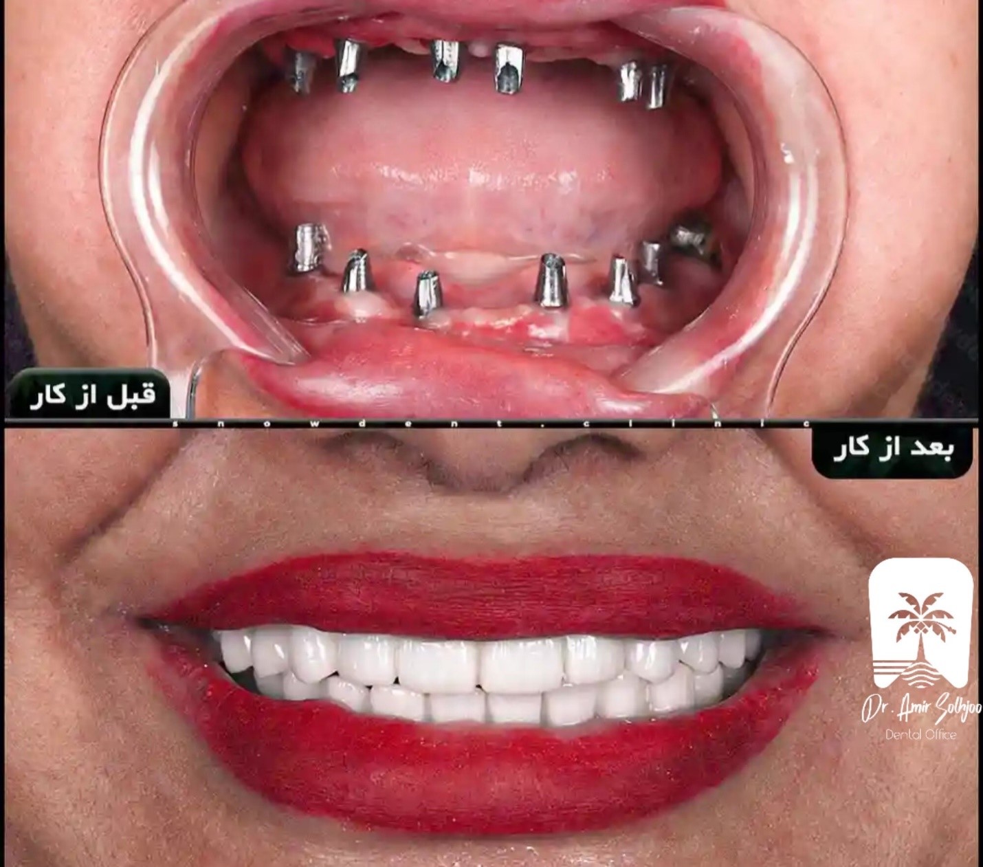 ایمپلنت تمام فک