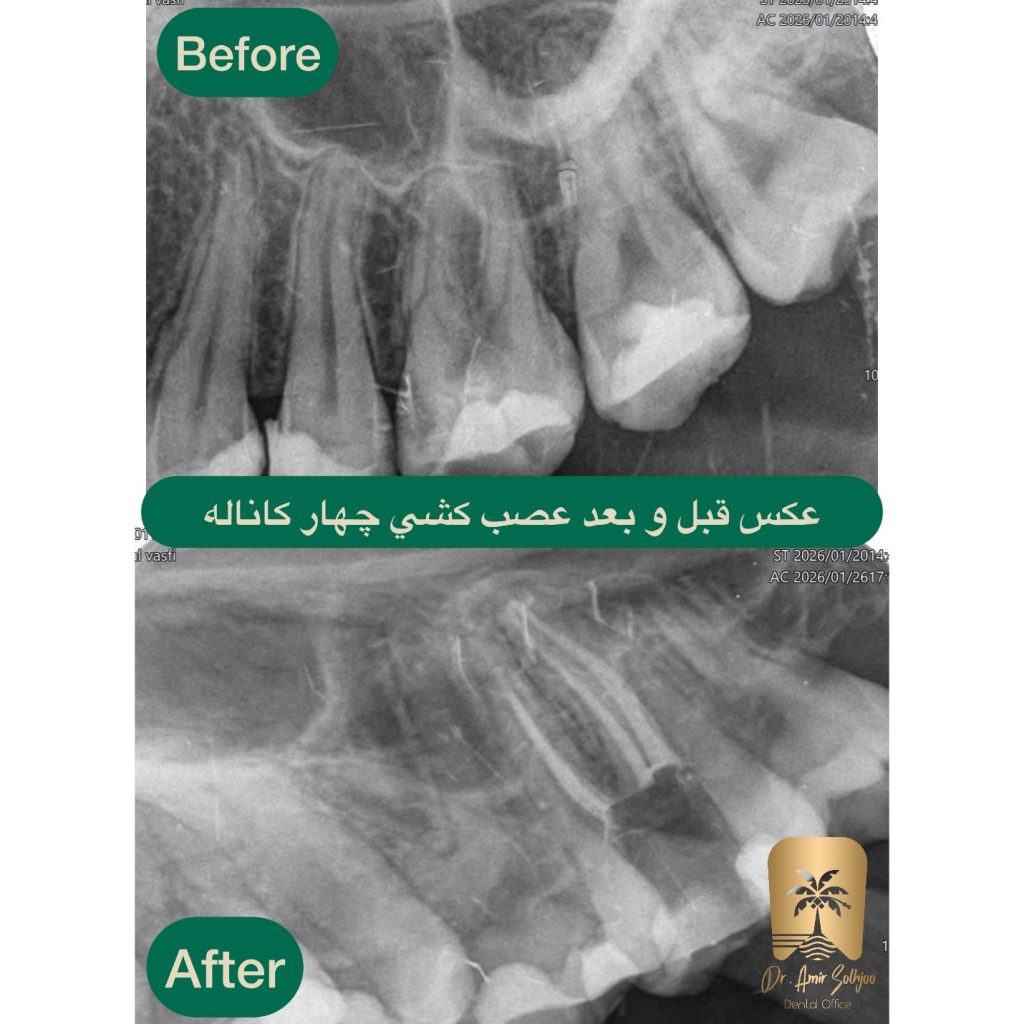 قیمت عصب کشی چهارکاناله