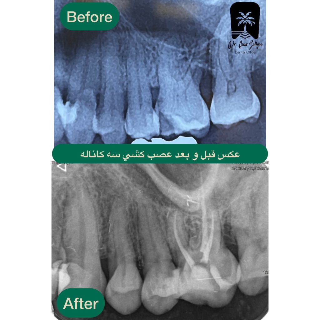 قیمت عصب کشی سه کاناله