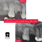 کشیدن دندان عقل روییده، نیمه نهفته، نهفته و روی عصب در یوسف آباد تهران
