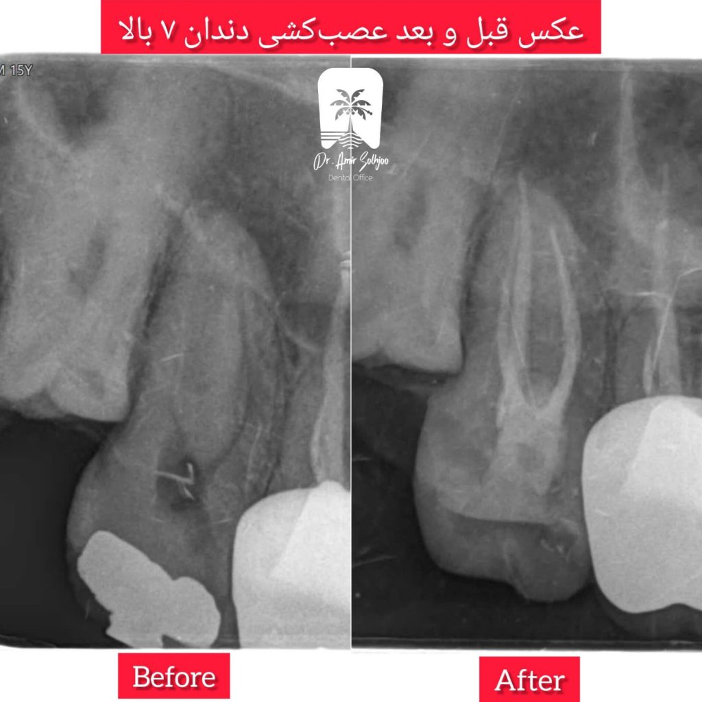عصبکشی دندان در یوسف آباد تهران