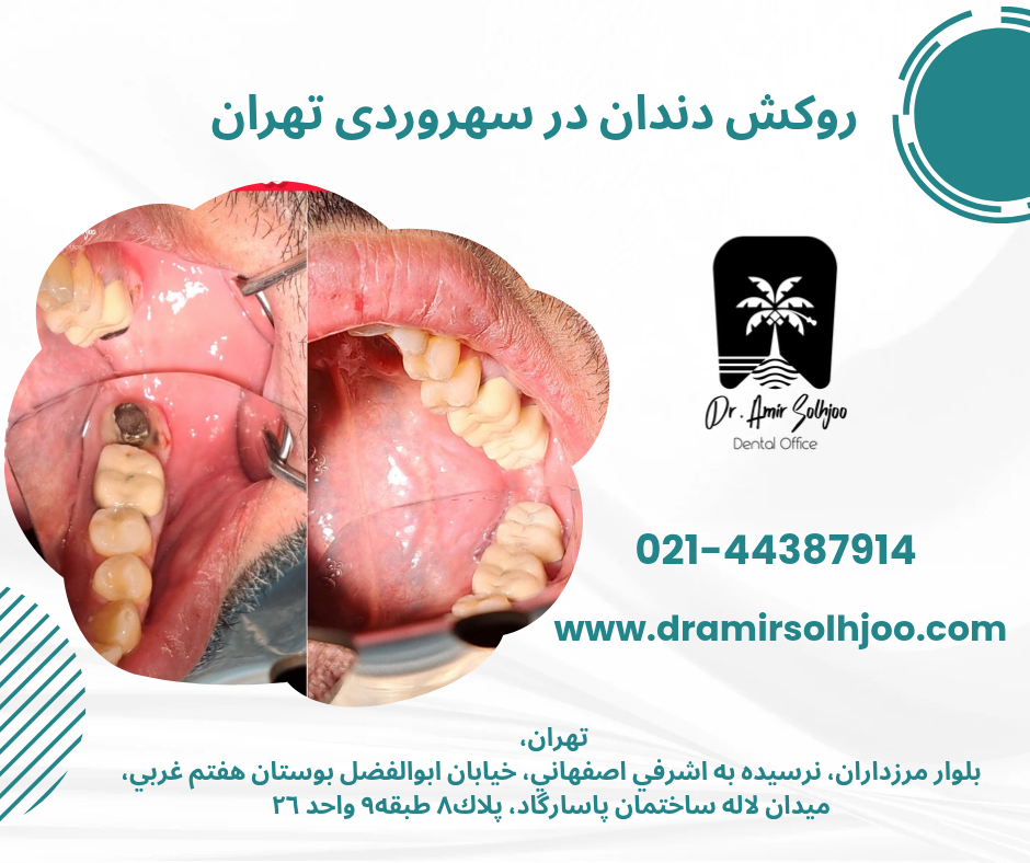 روکش دندان در سهروردی تهران