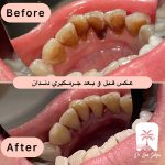 جرم گیری و برساژ دوفک