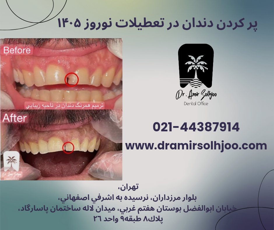 پرکردن دندان در تعطیلات نوروز ۱۴۰۵