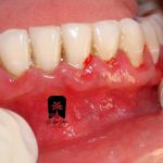 علائم اولیه بیماری‌های لثه
