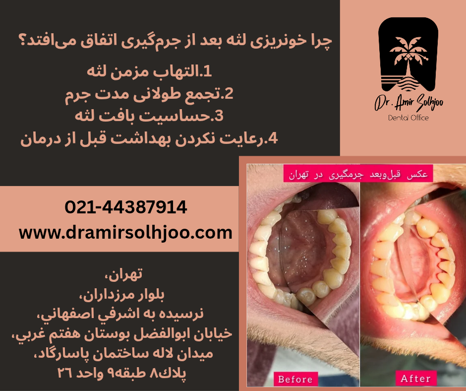 خونریزی لثه بعد از جرم گیری