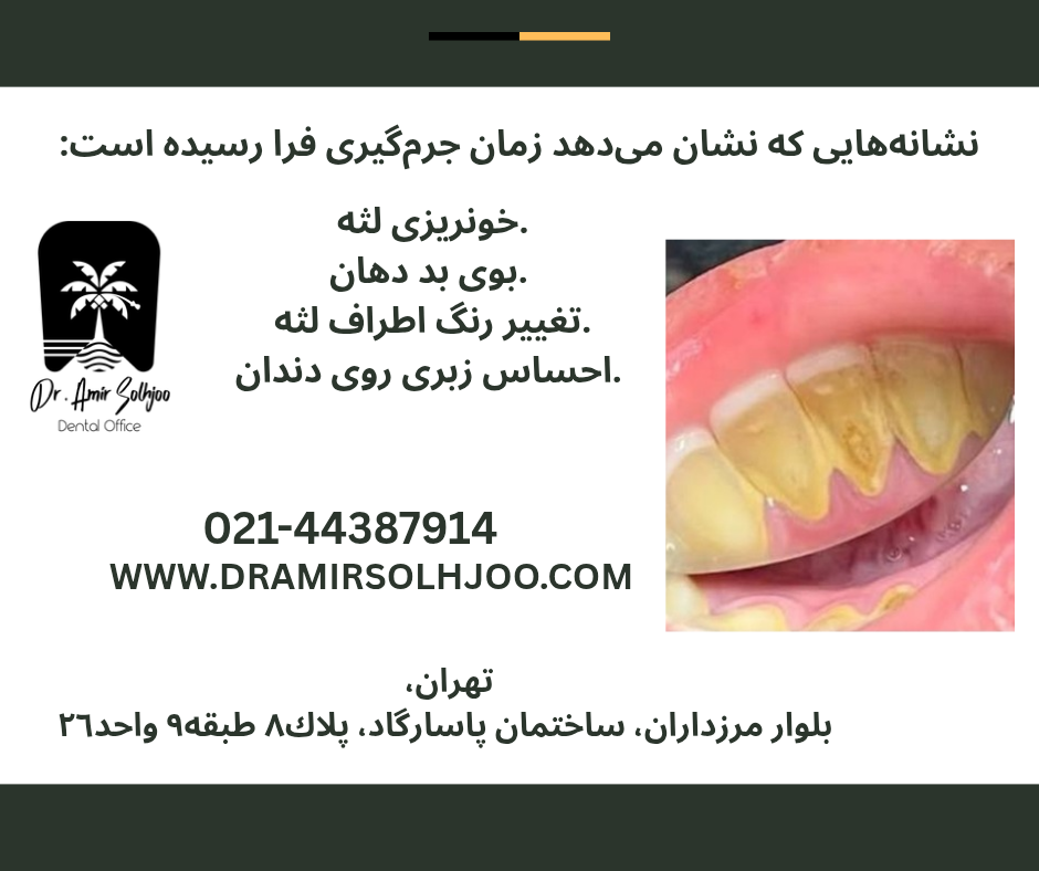 فاصله مناسب بین جرم گیریها