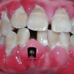 مراحل بیماری لثه از ژنژیویت تا پریودنتیت