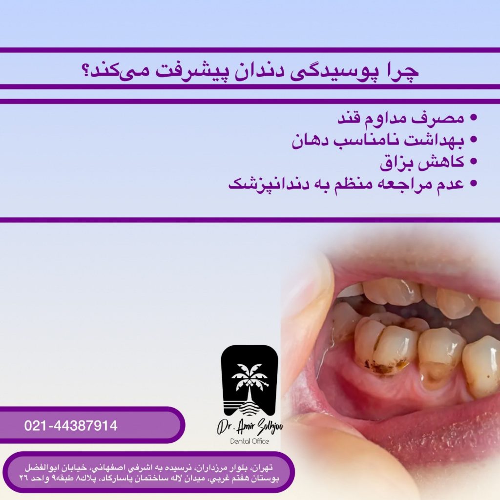 مراحل پیشرفت پوسیدگی دندان