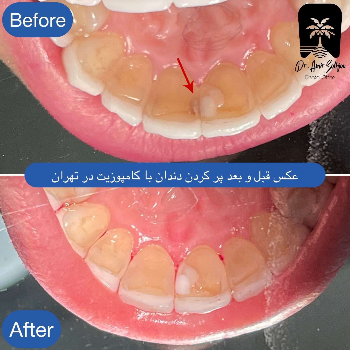 پرکردن دندان در تعطیلات نوروز ۱۴۰۵