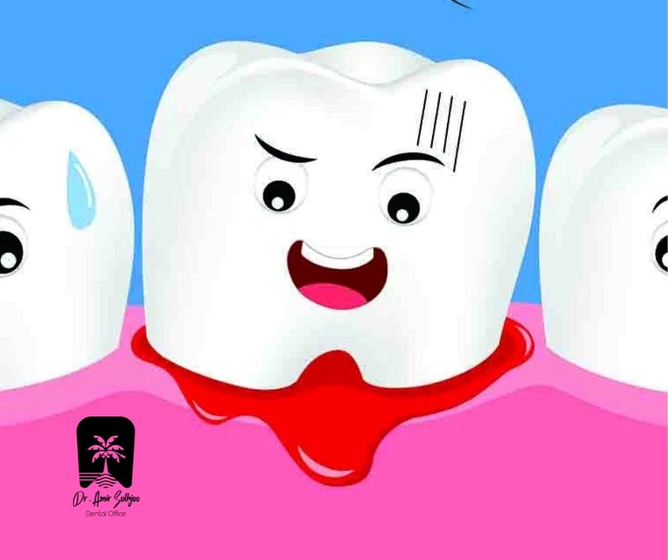خونریزی لثه بعد از جرم گیری