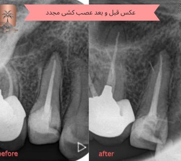 درمان سریع عفونت دندان عصب کشی شده
