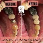 روکش دندان در سهروردی تهران