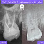 عصب کشی دندان در تعطیلات رسمی