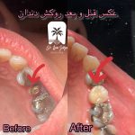 قیمت روکش دندان
