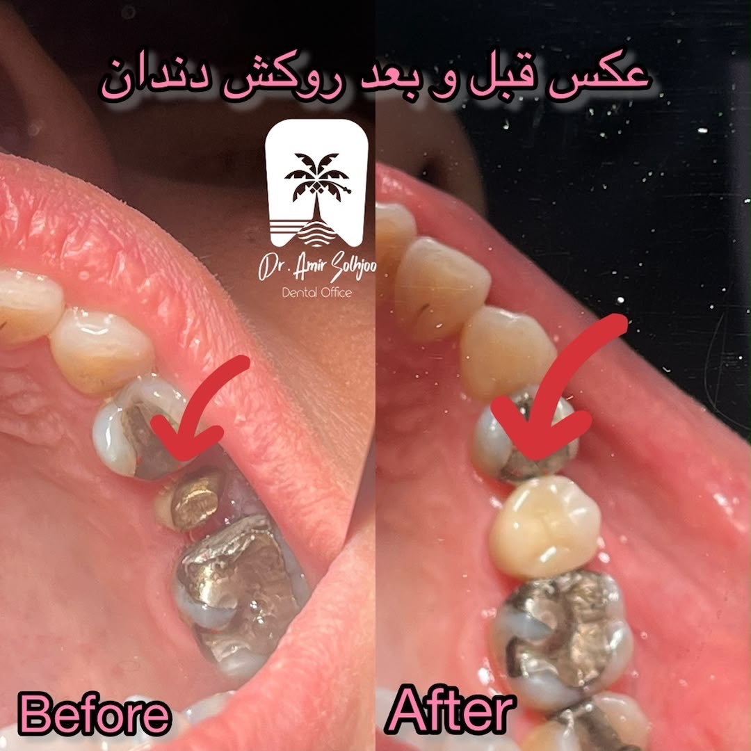 قیمت روکش دندان