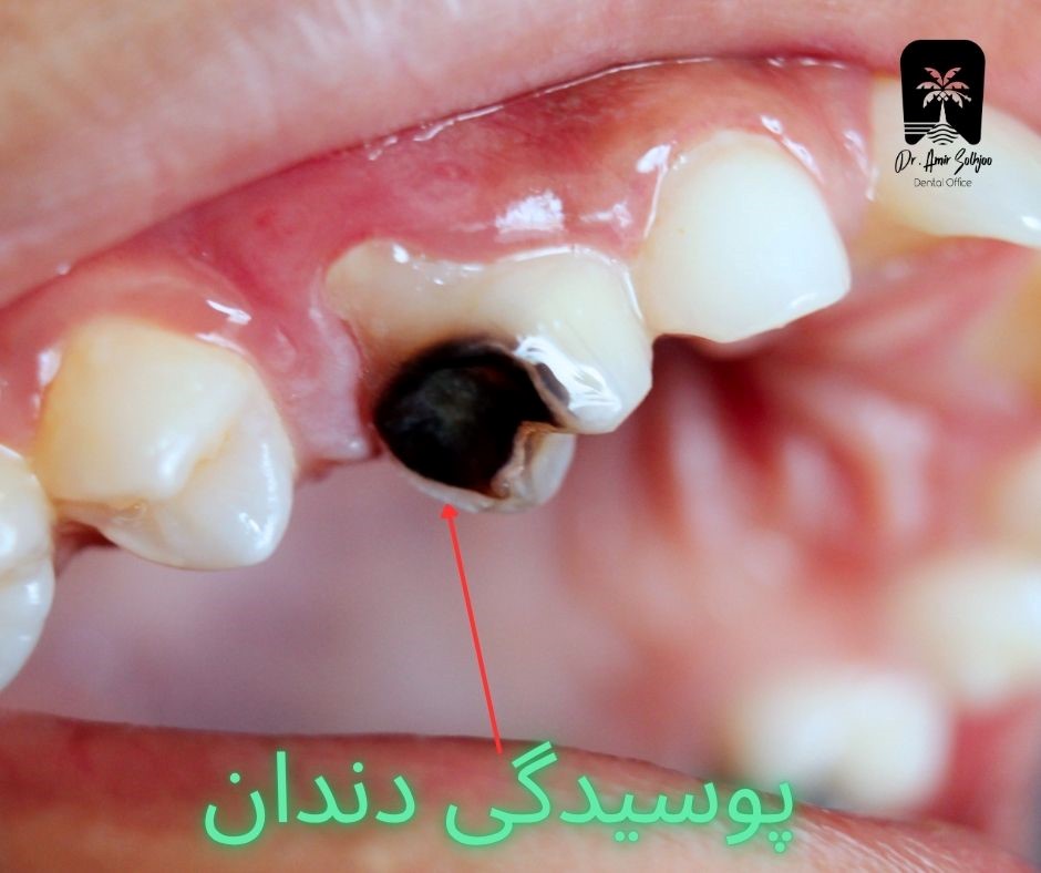 پوسیدگی دندان