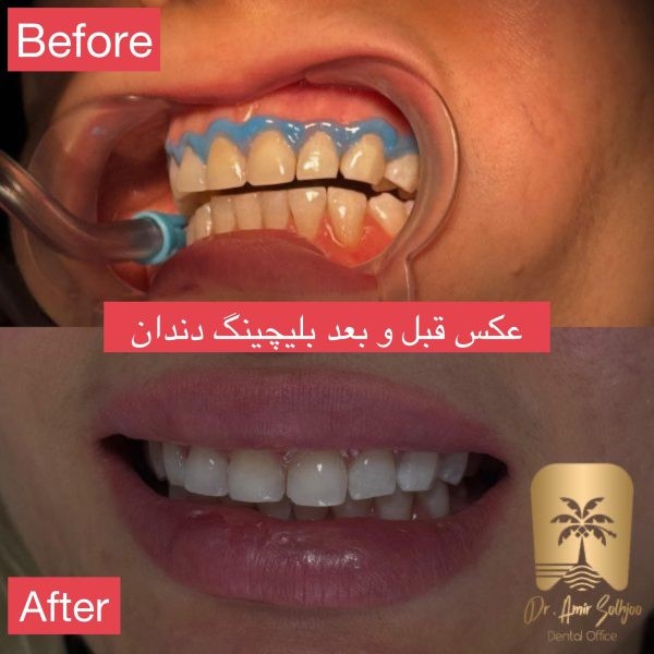بهترین دکتر بلیچینگ دندان در مرزداران تهران