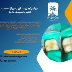 پرکردن دندان عصب کشی شده در مرزداران تهران