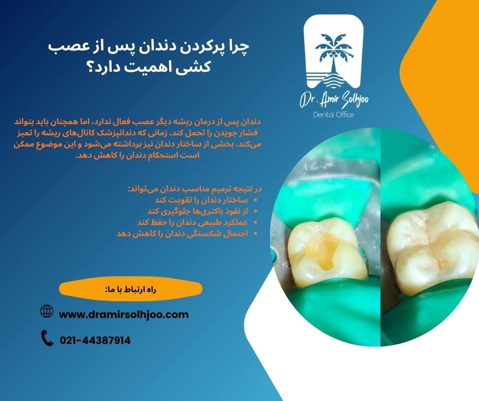 پرکردن دندان عصب کشی شده در مرزداران تهران