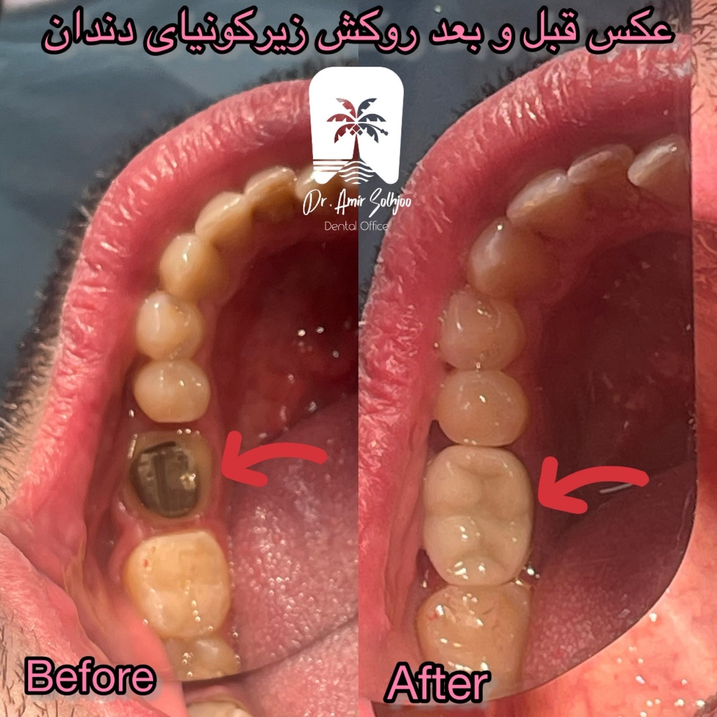 روکش زیرکونیا و تمام سرامیک دندان در مرزداران تهران؛ بررسی کامل