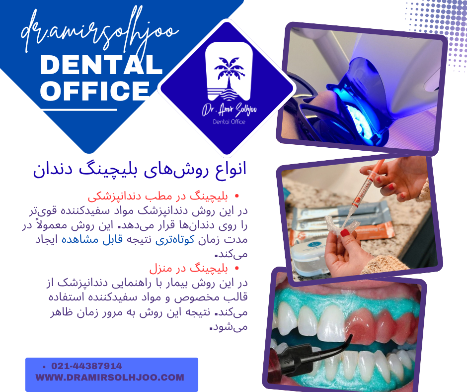 بهترین دکتر بلیچینگ دندان در مرزداران تهران