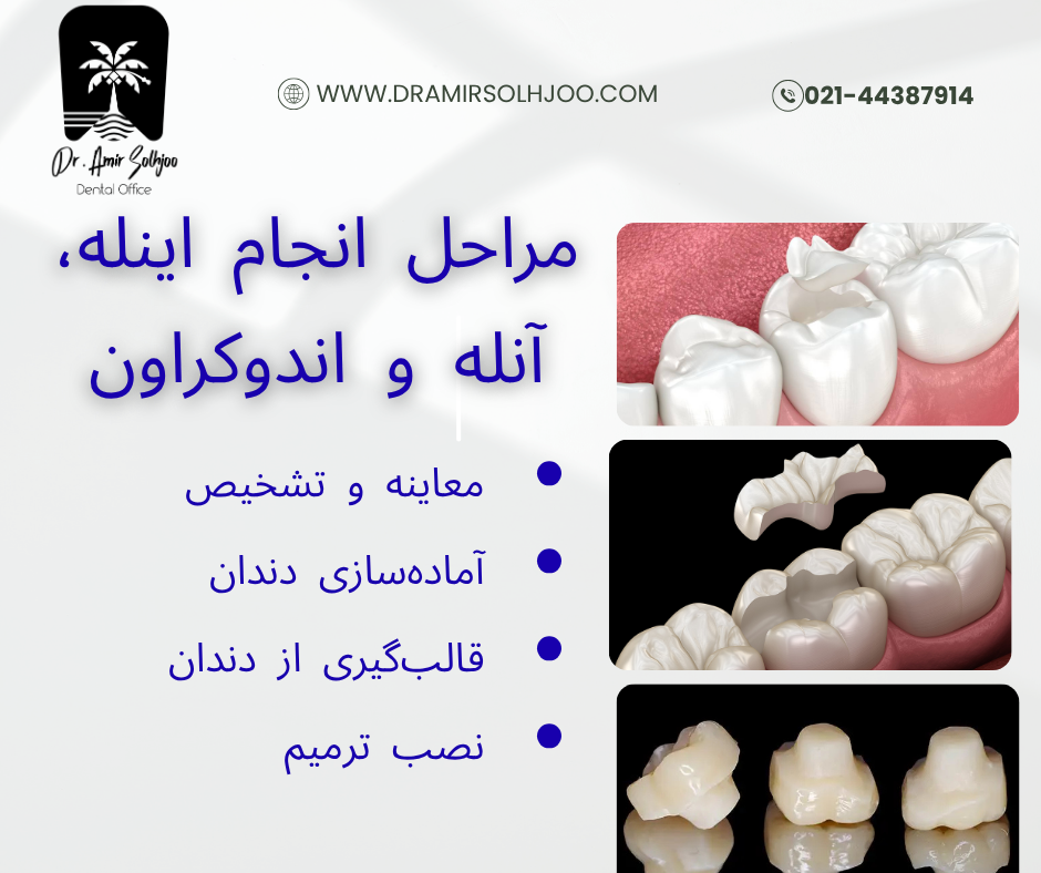 هزینه اینله ، آنله و اندوکراون دندان