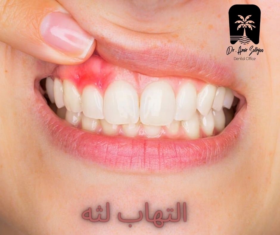 التهاب لثه