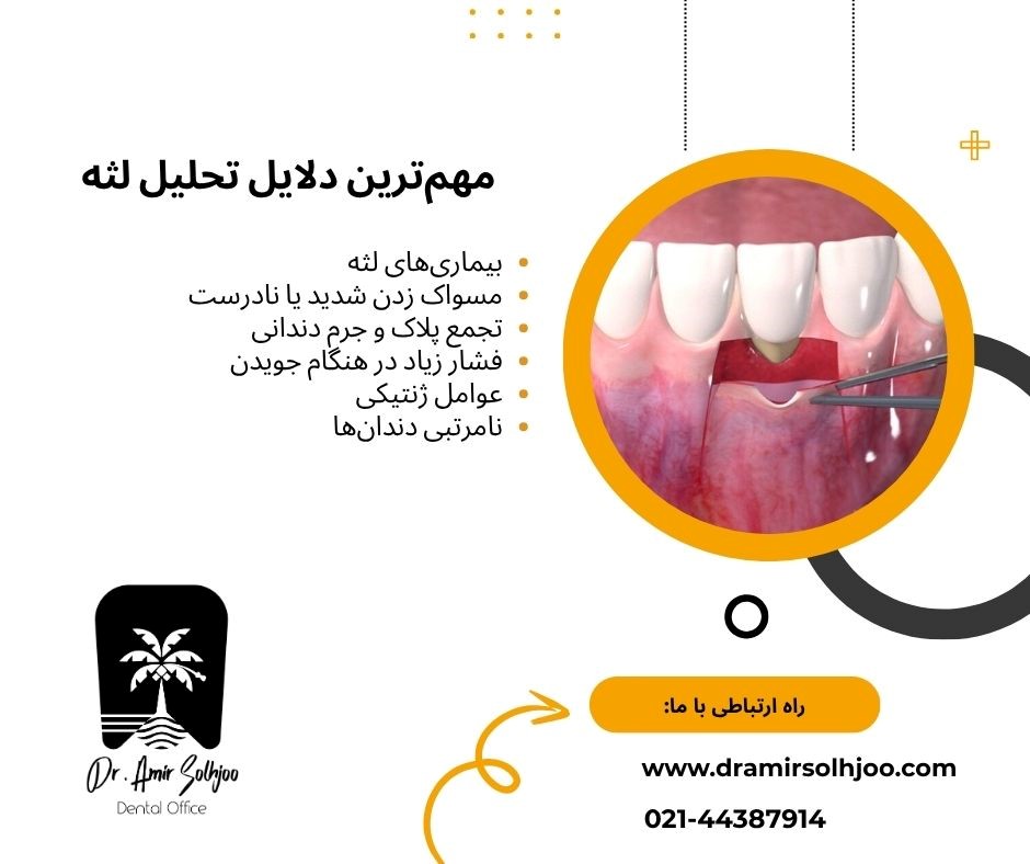 پیوند لثه