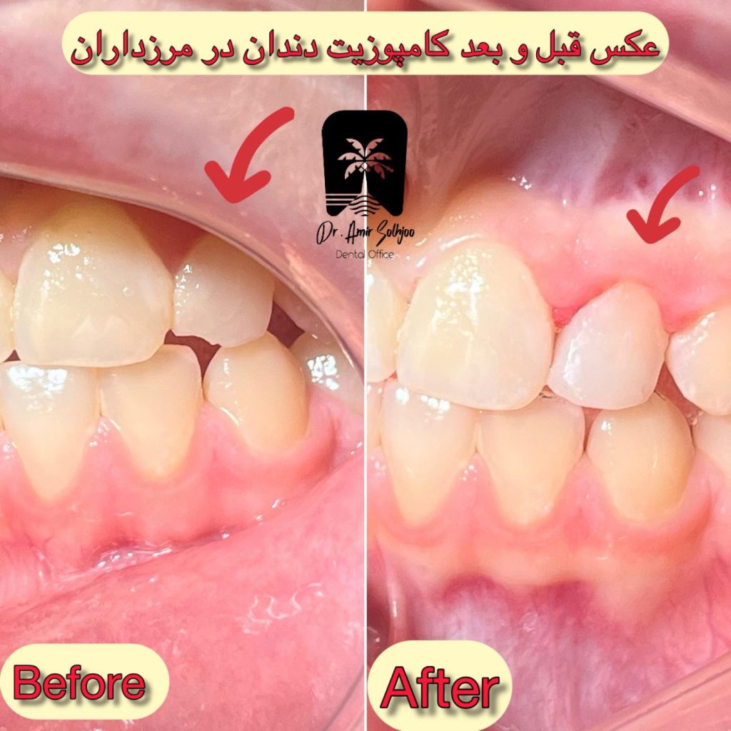 ترمیم دندان