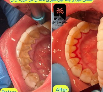 جزمگیری بالا لثه ای و زیر لثه ای در مرزداران