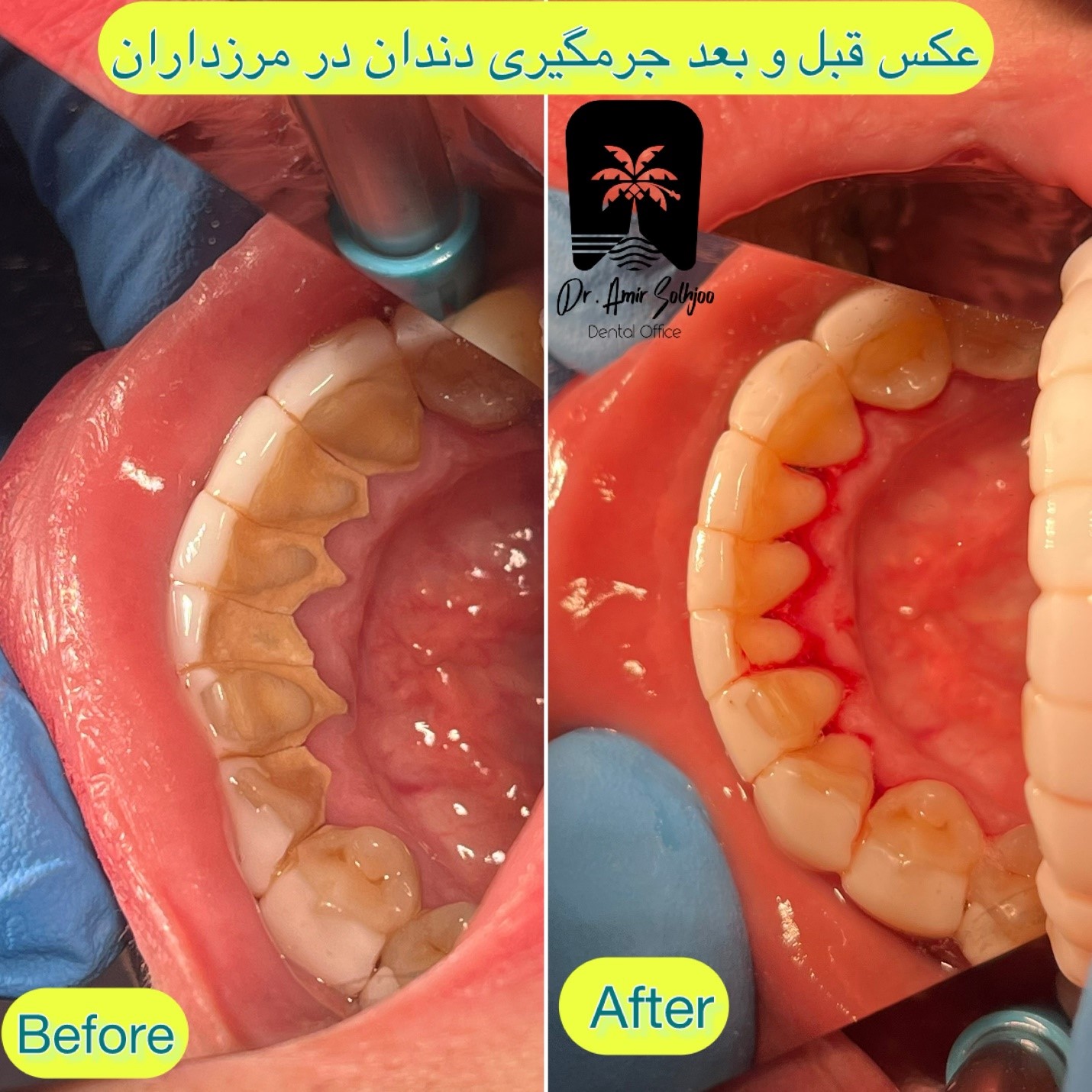 جزمگیری بالا لثه ای و زیر لثه ای در مرزداران