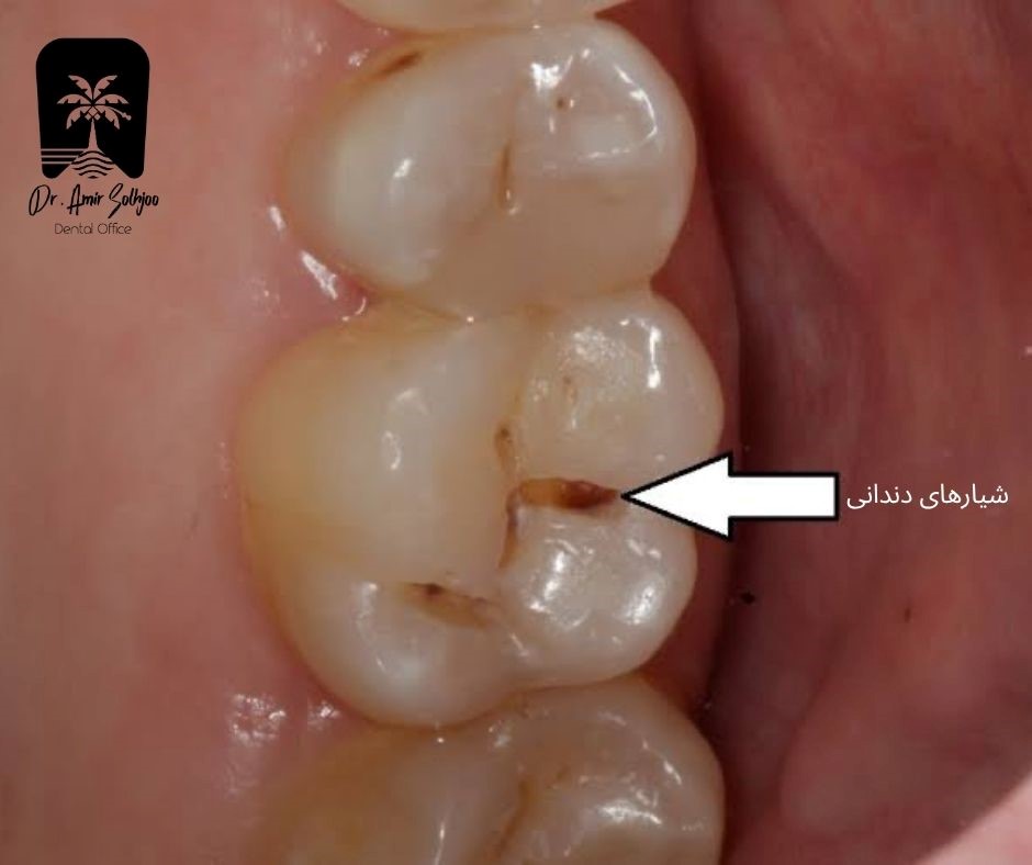 شیار های دندانی